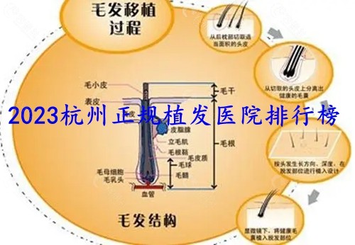 2023杭州正规植发医院排行榜
