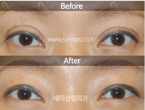 韩国世美整形外科双眼皮手术对比