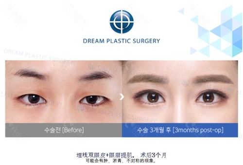 韩国梦想整形外科医院眼部整形对比照