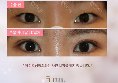 韩国爱护整形医院修复双眼皮对比照