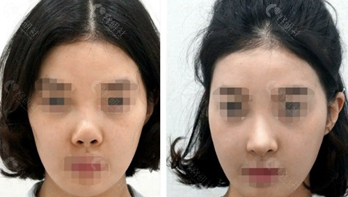 韩国优雅人挛缩鼻修复术前术后对比