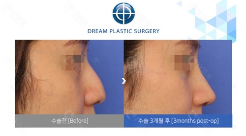 韩国梦想整形外科医院鼻子整形靠谱吗