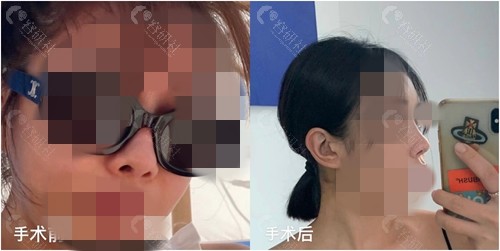韩国普罗菲耳整形外科医院鼻部整形价格