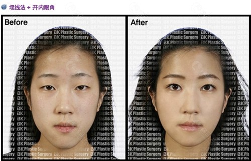 韩国BK整形外科开眼角手术对比图