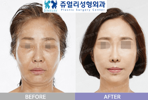 韩国珠儿丽整形外科面部提升对比