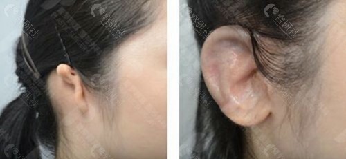韩国普罗菲耳整形外科医院耳朵整形对比照