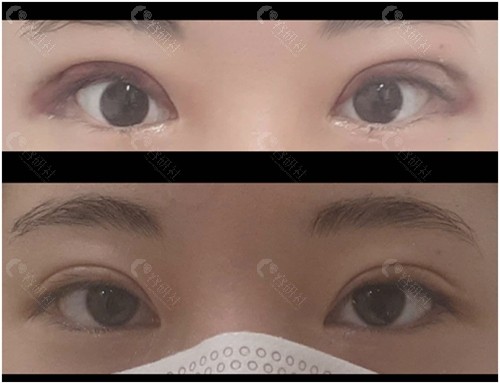 韩国爱护整形医院眼修复对比照