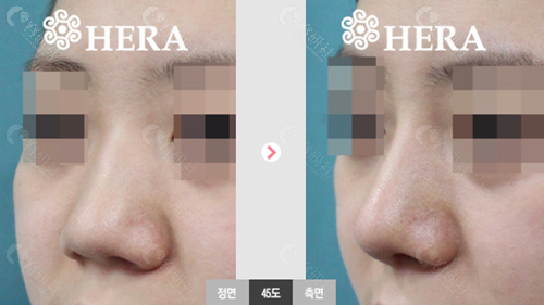 赫拉整形外科隆鼻对比