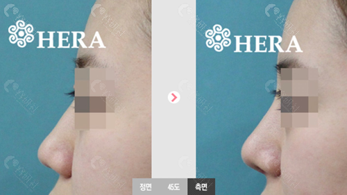 赫拉整形外科隆鼻前后对比