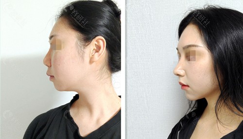 韩国优雅人鼻修复术前术后对比