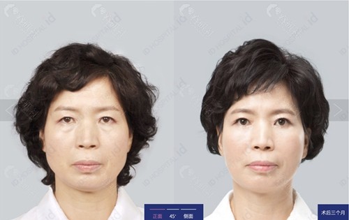 韩国ID整形外科医院拉皮手术对比照