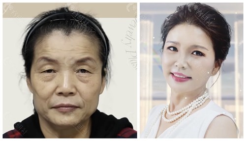韩国珠儿丽整形外科拉皮手术对比照