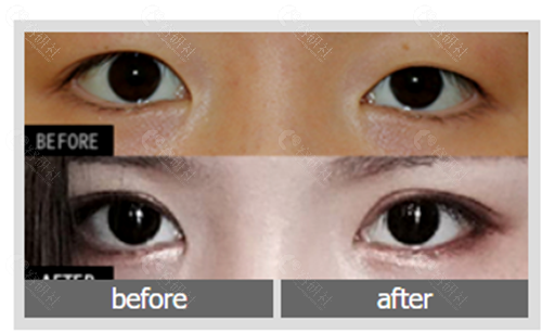 韩国爱护整形医院双眼皮手术对比图
