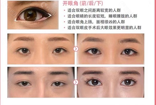 韩国珠儿丽整形外科开眼角手术对比图
