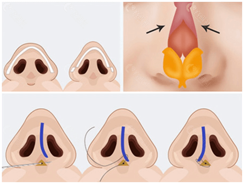 will整形外科鼻翼缩小方法