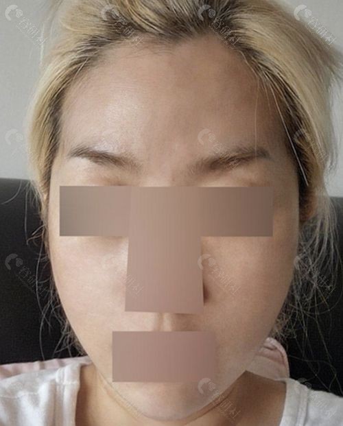 韩国珠儿丽整形外科面部吸脂+提拉手术后1个月