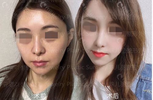 韩国珠儿丽整形外科颧骨缩小对比