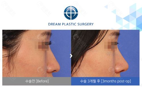 韩国梦想整形外科医院隆鼻对比