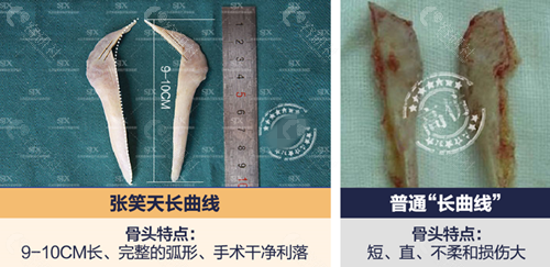 北京圣嘉新张笑天截骨下颌角