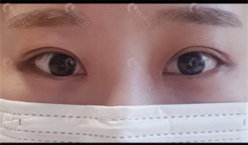 韩国珠儿丽整形外科埋线双眼皮术后