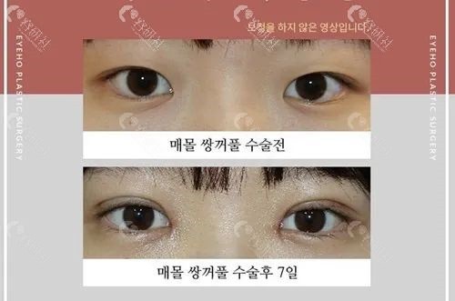 韩国爱护医院双眼皮对比照