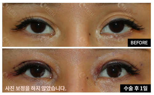 韩国爱护整形医院香肠眼修复对比