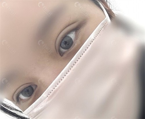 韩国普罗菲耳整形外科医院埋线双眼皮
