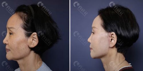韩国歌柔飞整形外科医院面颈部拉皮手术前后对比照