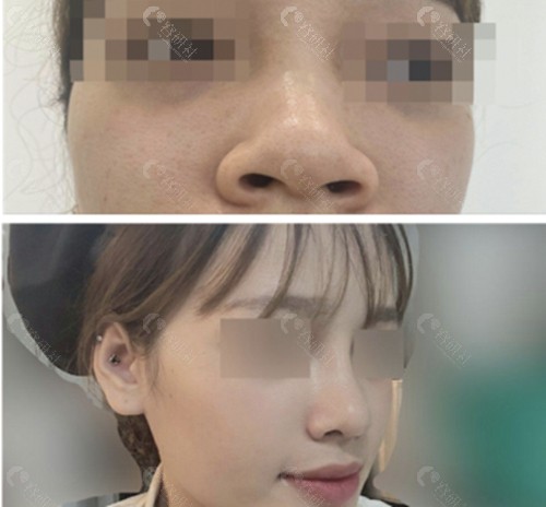 韩国温度隆鼻术前术后对比图