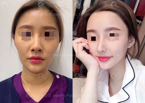 韩国珠儿丽整形外科隆鼻修复对比图