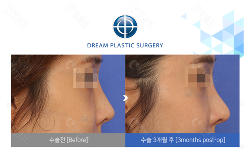 韩国梦想整形外科医院鼻修复对比