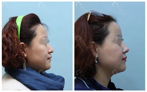 韩国爱护整形医院鼻修复对比