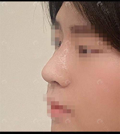 韩国WILL整形外科矮鼻整形手术前照片
