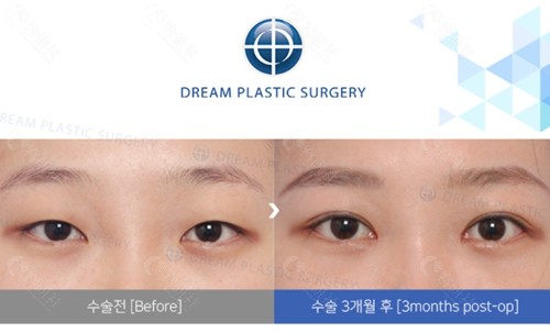 韩国梦想整形外科医院眼部整形对比图