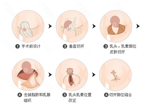 缩胸手术方法