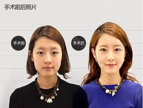 韩国必当归医院眼部整形前后