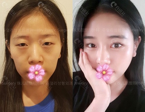 韩国珠儿丽整形外科双眼皮对比照