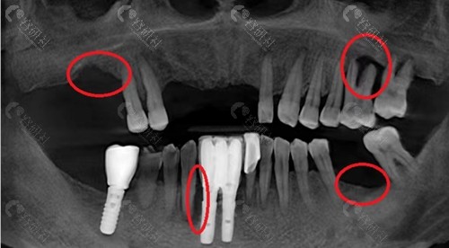 牙周炎导致牙齿脱落需要种植牙