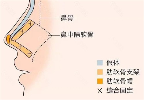 杜太超做鼻子价格贵不贵？