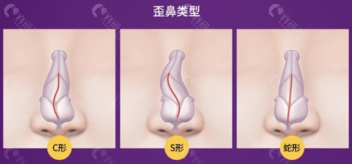 韩国梦想整形外科医院歪鼻矫正怎么样？