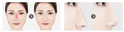 韩国431整形外科隆鼻对比