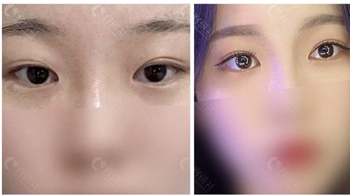 韩国TS整形医院眼部修复对比图