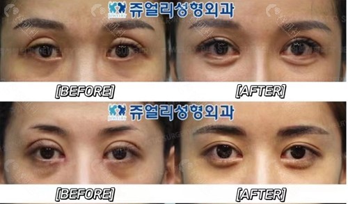 韩国珠儿丽整形外科双眼皮修复对比图
