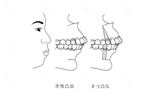 牙性和骨性凸嘴区别