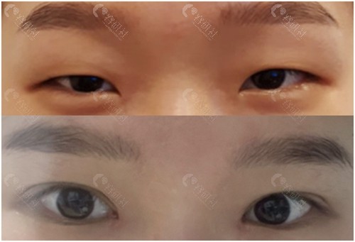 韩国爱护整形医院割双眼皮对比照