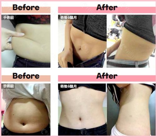 韩国欧佩拉腰腹部吸脂减肥术前和术后6个月图片