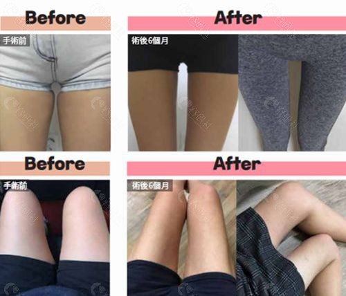 韩国欧佩拉整形外科大腿吸脂6个月恢复图片