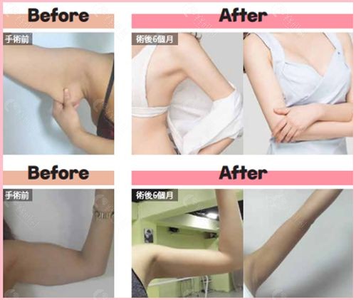 韩国欧佩拉整形外科医院手臂吸脂前后图片对比