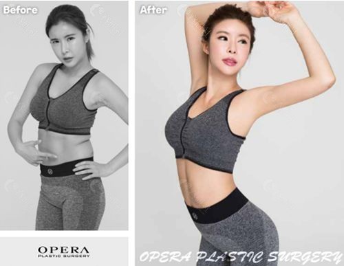 韩国欧佩拉整形外科吸脂减肥塑形术怎么样？