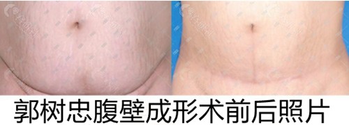 西安国际医学郭树忠腹壁成形术前后照片